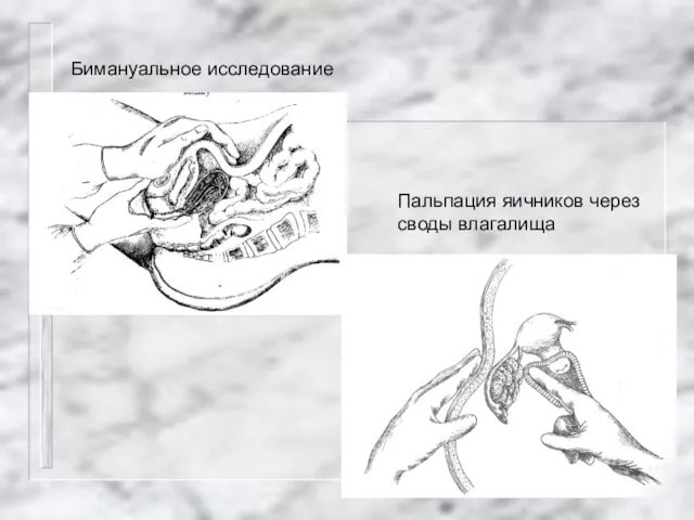 Бимануальное исследование Пальпация яичников через своды влагалища