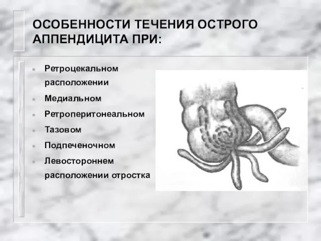 ОСОБЕННОСТИ ТЕЧЕНИЯ ОСТРОГО АППЕНДИЦИТА ПРИ: Ретроцекальном расположении Медиальном Ретроперитонеальном Тазовом Подпеченочном Левостороннем расположении отростка