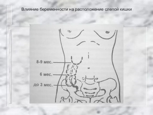 Влияние беременности на расположение слепой кишки