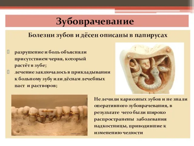 Зубоврачевание Болезни зубов и дёсен описаны в папирусах разрушение и боль