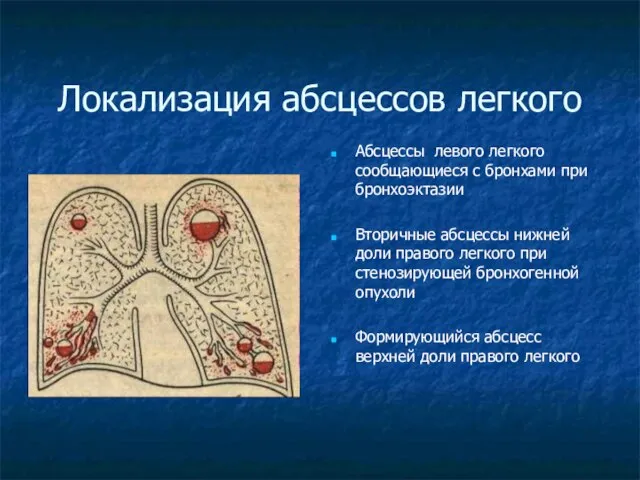 Локализация абсцессов легкого Абсцессы левого легкого сообщающиеся с бронхами при бронхоэктазии