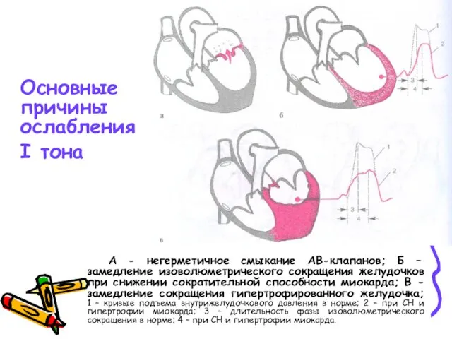 Основные причины ослабления I тона А - негерметичное смыкание АВ-клапанов; Б