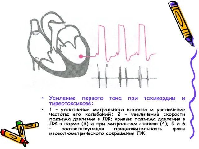 Усиление первого тона при тахикардии и тиреотоксикозе: 1 – уплотнение митрального