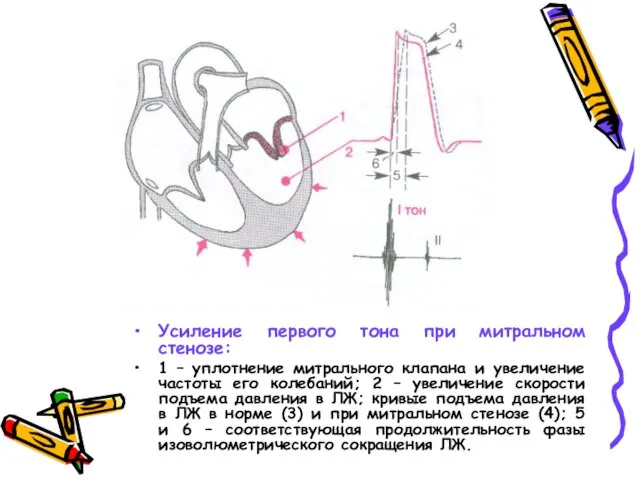 Усиление первого тона при митральном стенозе: 1 – уплотнение митрального клапана