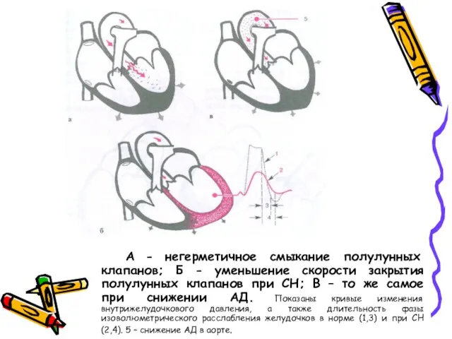 А - негерметичное смыкание полулунных клапанов; Б - уменьшение скорости закрытия