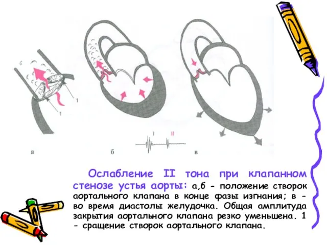 Ослабление II тона при клапанном стенозе устья аорты: а,б - положение