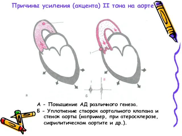 Причины усиления (акцента) II тона на аорте А - Повышение АД