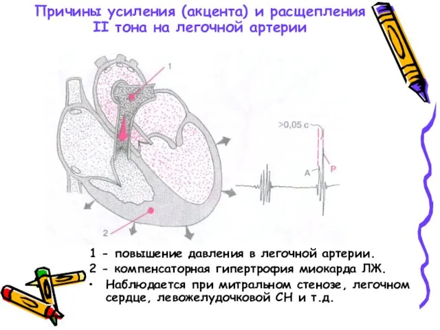 Причины усиления (акцента) и расщепления II тона на легочной артерии 1