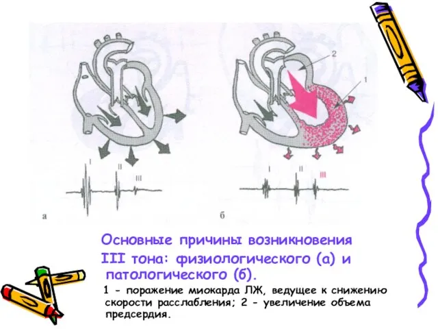 Основные причины возникновения III тона: физиологического (а) и патологического (б). 1
