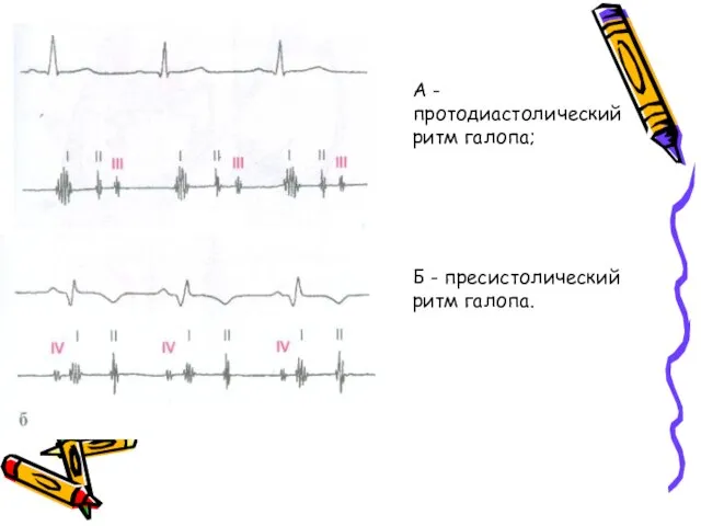 А - протодиастолический ритм галопа; Б - пресистолический ритм галопа.