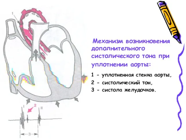 Механизм возникновения дополнительного систолического тона при уплотнении аорты: 1 - уплотненная