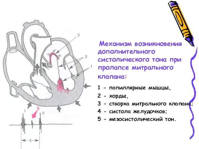 Механизм возникновения дополнительного систолического тона при пролапсе митрального клапана: 1 -