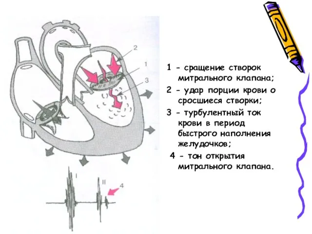 1 - сращение створок митрального клапана; 2 - удар порции крови