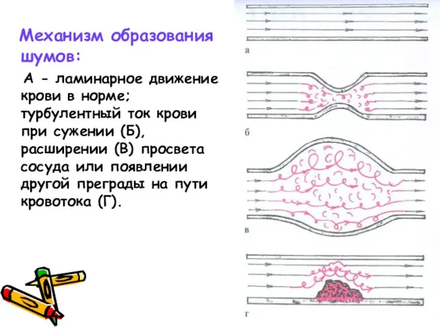 Механизм образования шумов: А - ламинарное движение крови в норме; турбулентный