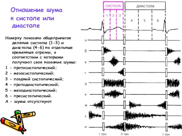 Отношение шума к систоле или диастоле Наверху показано общепринятое деление систолы