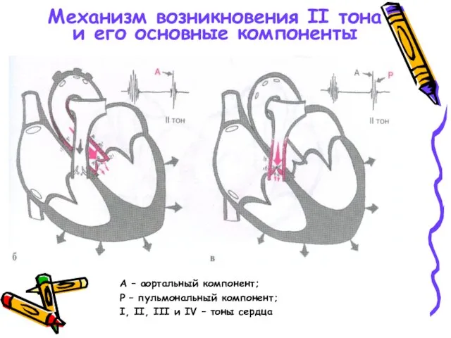 Механизм возникновения II тона и его основные компоненты А – аортальный