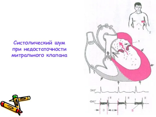 Систолический шум при недостаточности митрального клапана