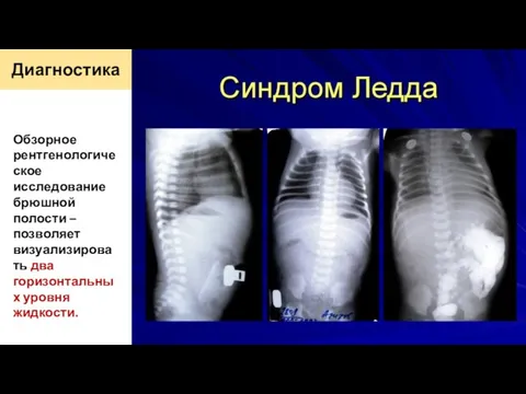 Диагностика Обзорное рентгенологическое исследование брюшной полости – позволяет визуализировать два горизонтальных уровня жидкости.