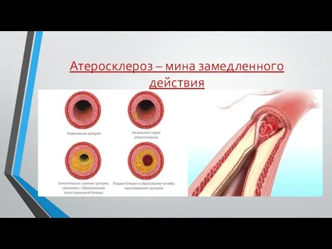 Атеросклероз – мина замедленного действия