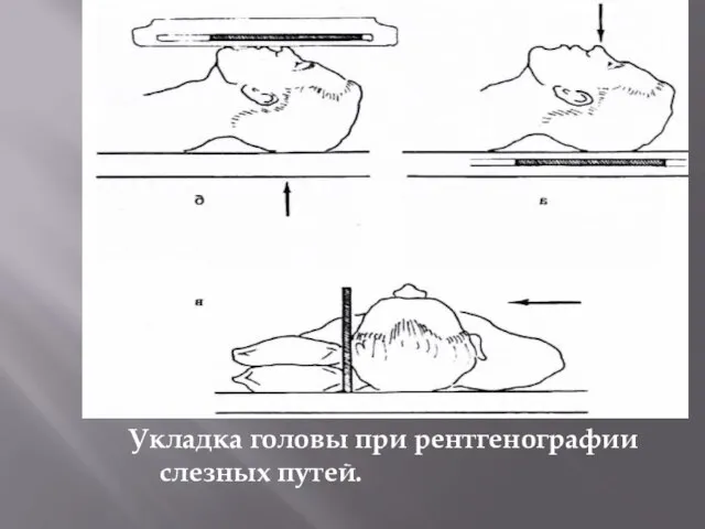 Укладка головы при рентгенографии слезных путей.