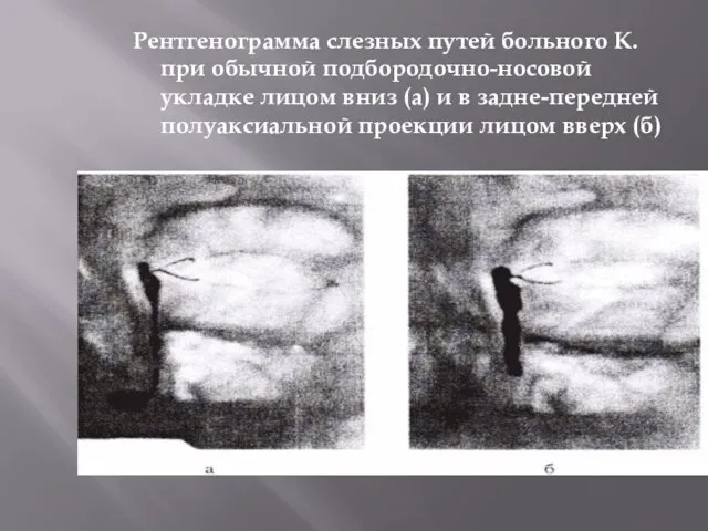 Рентгенограмма слезных путей больного К. при обычной подбородочно-носовой укладке лицом вниз