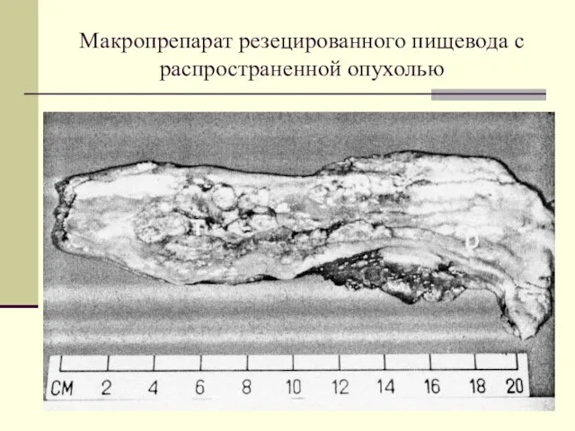 Макропрепарат резецированного пищевода с распространенной опухолью