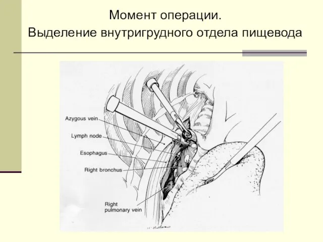 Момент операции. Выделение внутригрудного отдела пищевода
