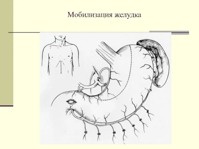 Мобилизация желудка