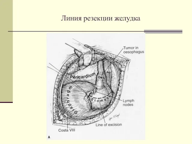 Линия резекции желудка