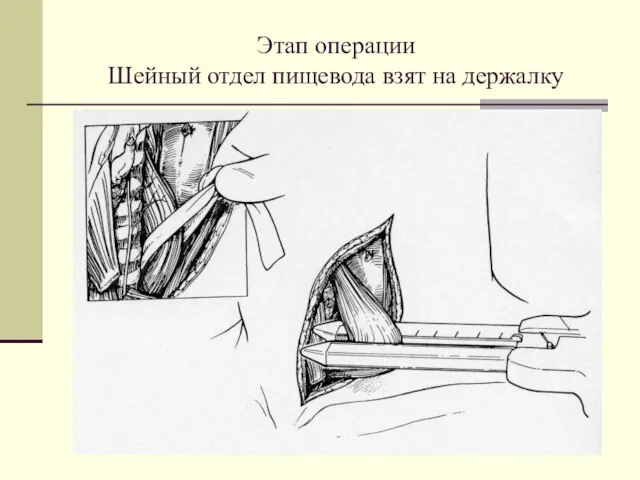 Этап операции Шейный отдел пищевода взят на держалку