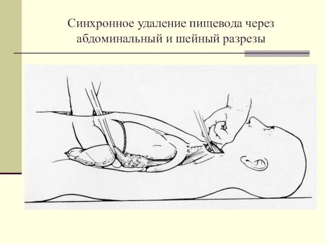 Синхронное удаление пищевода через абдоминальный и шейный разрезы