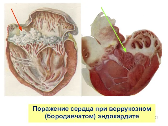 Поражение сердца при веррукозном (бородавчатом) эндокардите