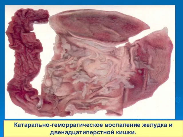 Катарально-геморрагическое воспаление желудка и двенадцатиперстной кишки.