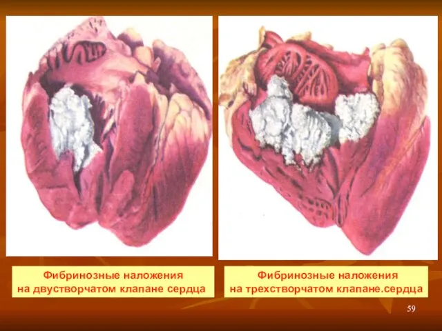 Фибринозные наложения на двустворчатом клапане сердца. Фибринозные наложения на трехстворчатом клапане.сердца