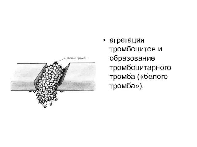 агрегация тромбоцитов и образование тромбоцитарного тромба («белого тромба»).