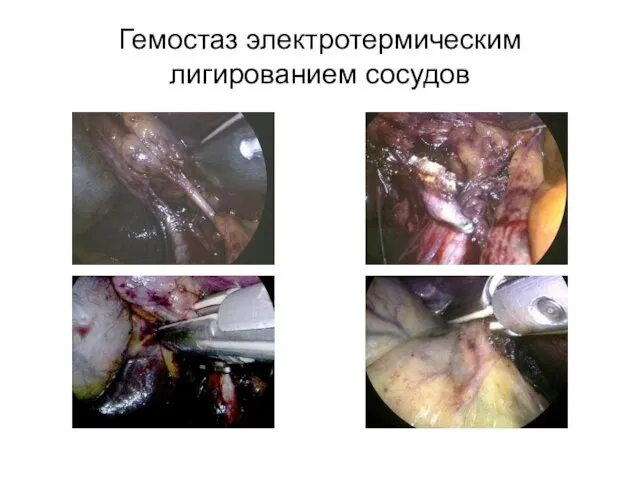 Гемостаз электротермическим лигированием сосудов