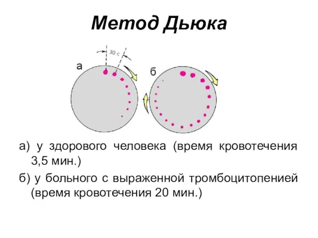 Метод Дьюка а) у здорового человека (время кровотечения 3,5 мин.) б)