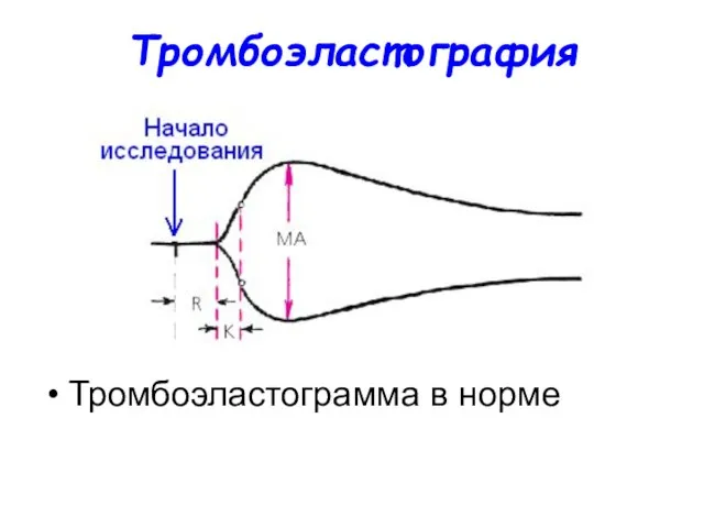 Тромбоэластография Тромбоэластограмма в норме