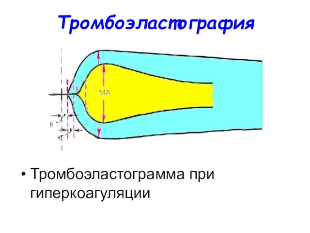 Тромбоэластография Тромбоэластограмма при гиперкоагуляции