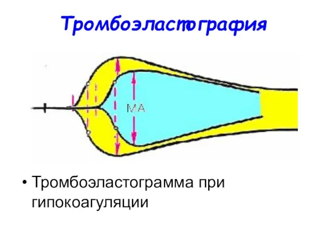 Тромбоэластография Тромбоэластограмма при гипокоагуляции