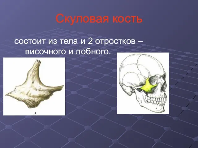 Скуловая кость состоит из тела и 2 отростков – височного и лобного.