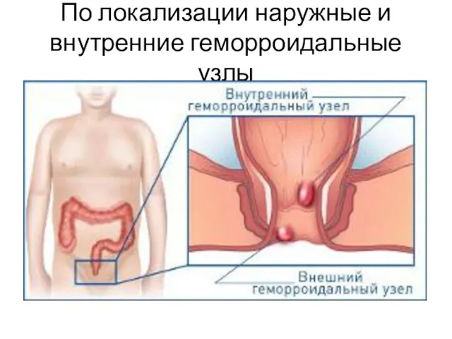 По локализации наружные и внутренние геморроидальные узлы