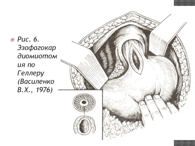 Рис. 6. Эзофагокардиомиотомия по Геллеру (Василенко В.Х., 1976)