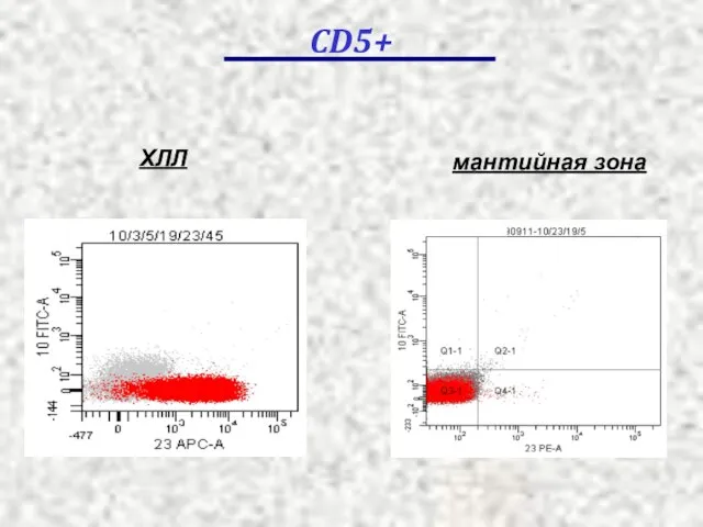 ХЛЛ мантийная зона CD5+
