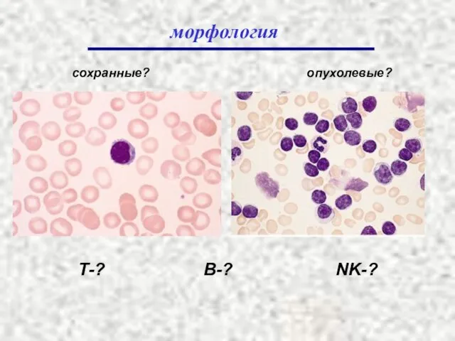 морфология сохранные? опухолевые? Т-? В-? NK-?