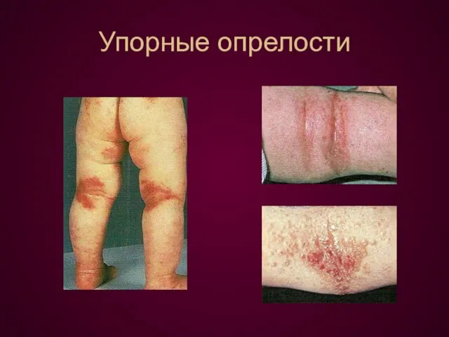 Упорные опрелости