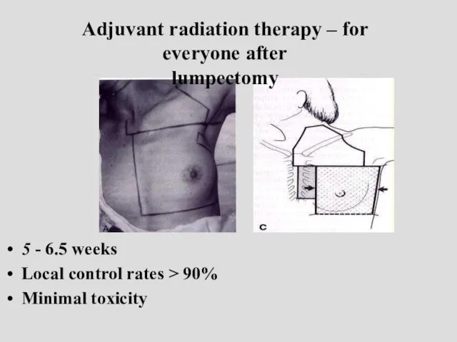 Adjuvant radiation therapy: 5 - 6.5 weeks Local control rates >