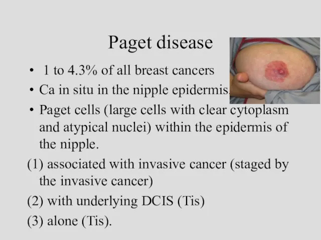 Paget disease 1 to 4.3% of all breast cancers Ca in