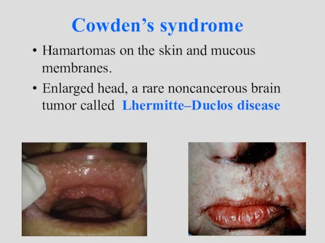 Cowden’s syndrome Hamartomas on the skin and mucous membranes. Enlarged head,