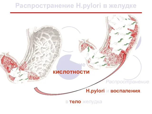 в тело желудка Распространение Н.pylori и воспаления, Распространение Н.pylori в желудке снижение кислотности